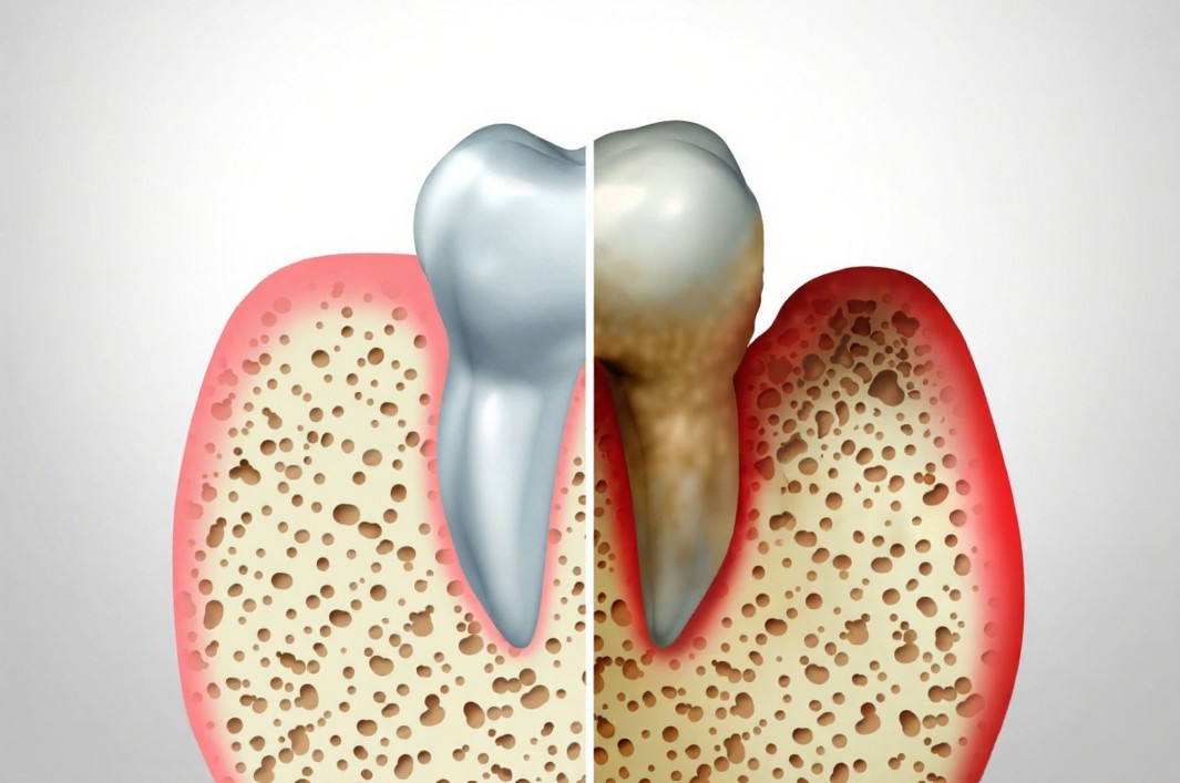 Gum Disease Illustration